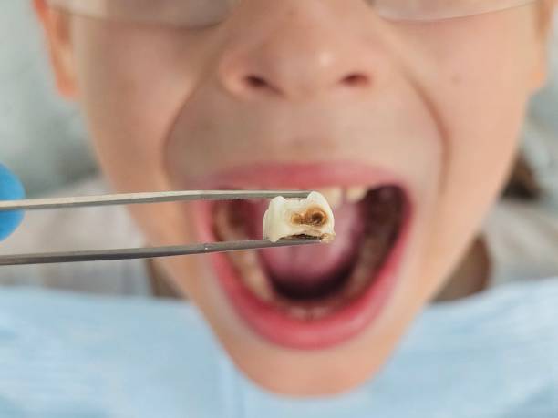 Best Emergency Wisdom Teeth Removal in Forest Hills, TN
